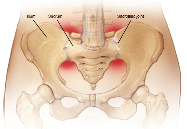 sacroilitis